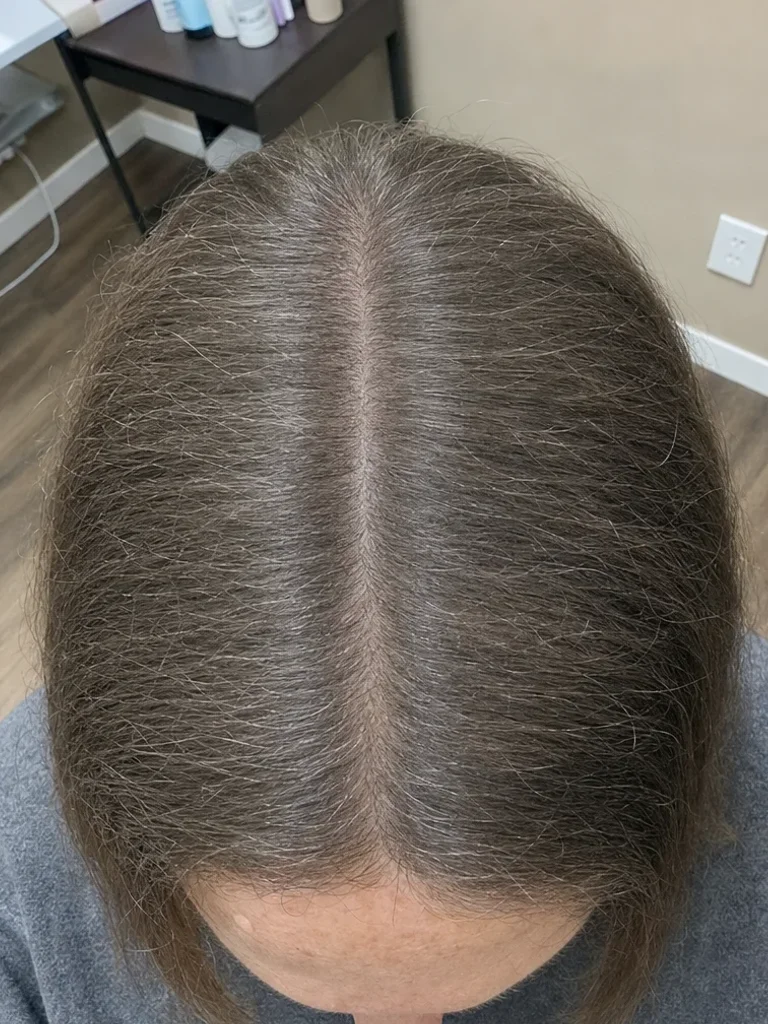 After PRP hair treatment