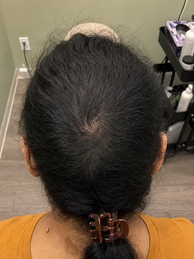 After PRP hair treatment