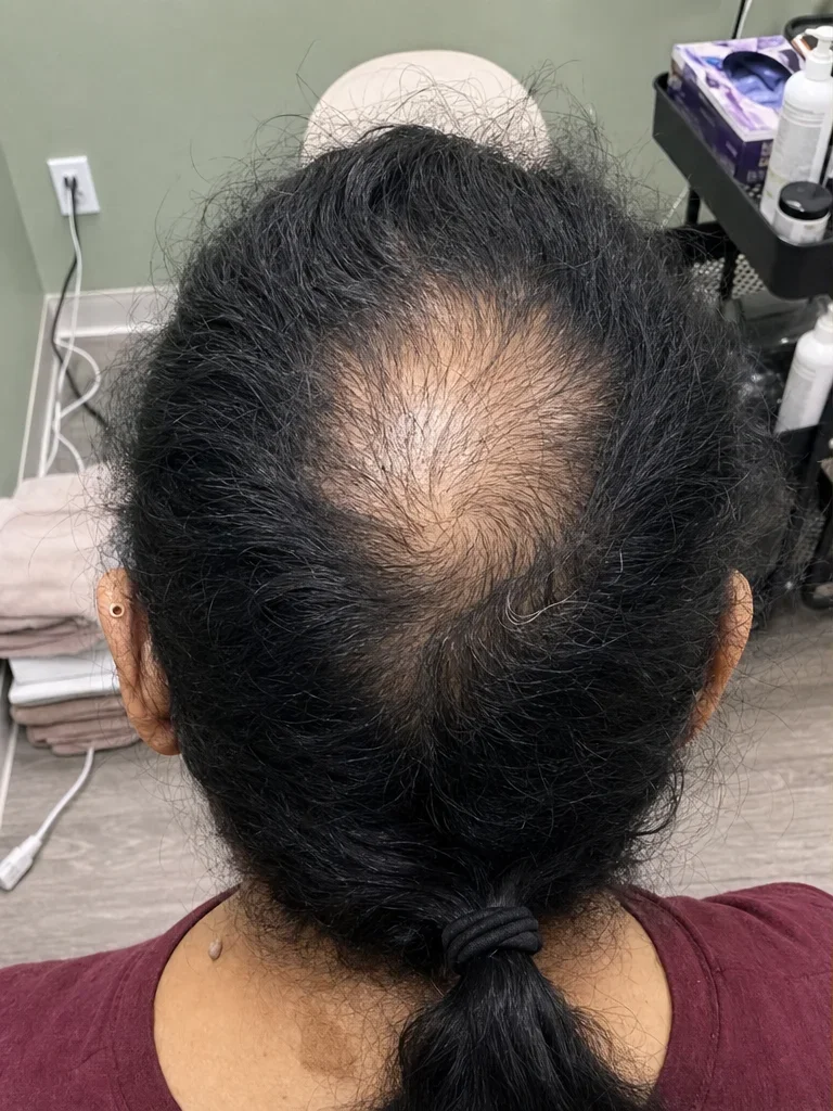 Before PRP hair treatment