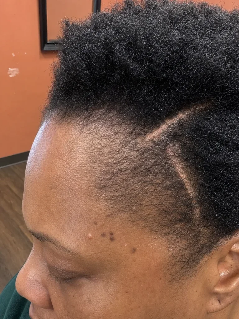 After PRP hair treatment
