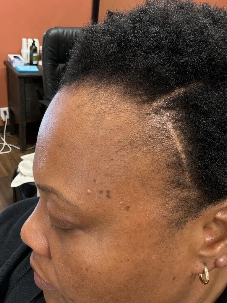 Before PRP hair treatment