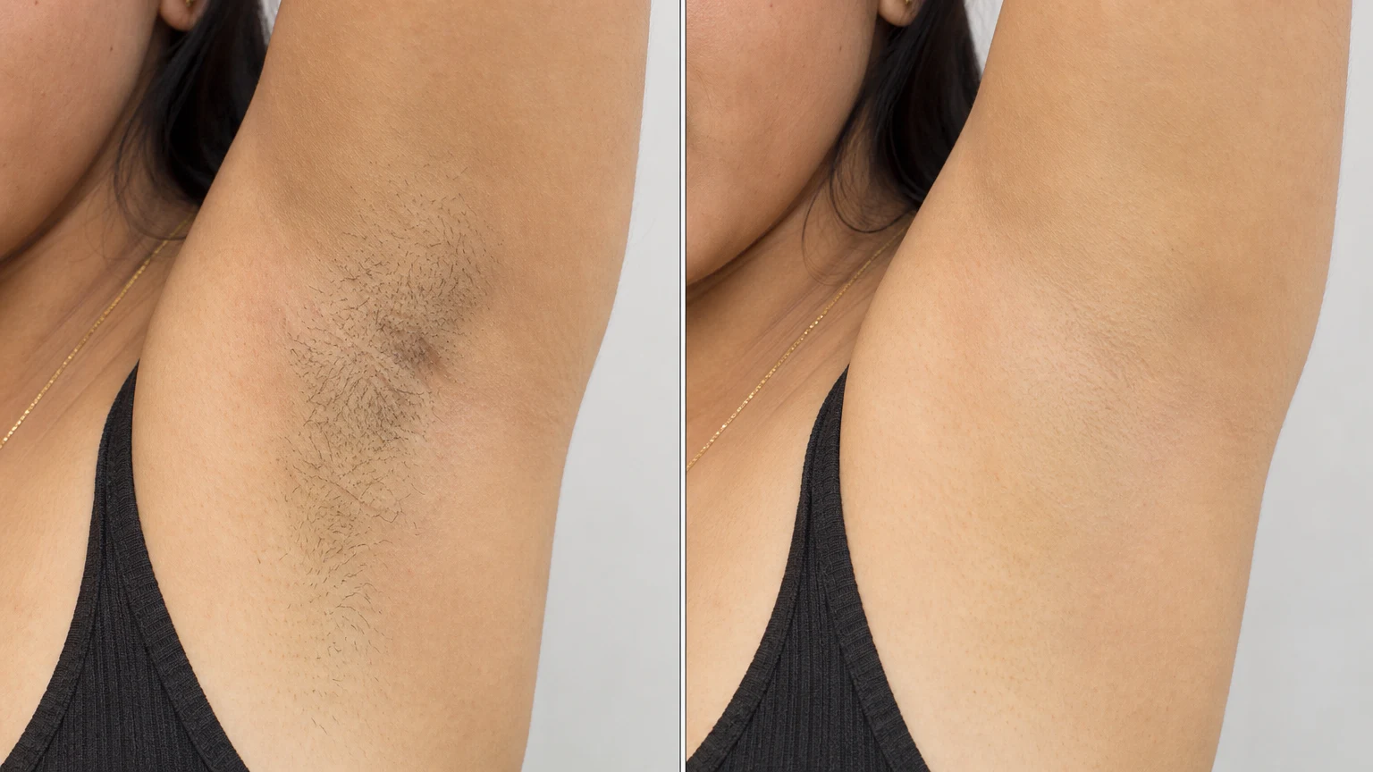 Before-and-after example of smooth, hair-free skin after laser hair removal.